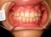 Ortodontia depois